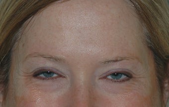 Botox Treatment before 94106