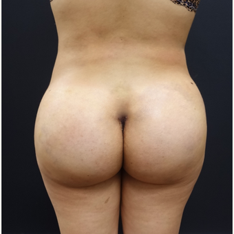 18-24 year old woman treated with 548cc Butt Implants and 400cc of fat transfer after 2764744