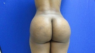 32 year old Brazilian Butt Lift after 1069857
