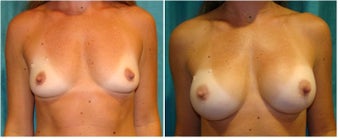 Breast Augmentation Silicone before 1017133