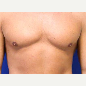 35-44 year old man treated with Male Breast Reduction before 3066179