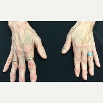 75 and up year old woman treated with 2 syringes of Radiesse before 3784352