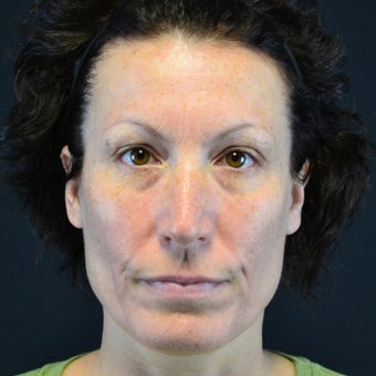 45-54 year old woman treated with Restylane before 2255617