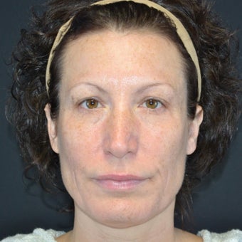 45-54 year old woman treated with Restylane after 2255617