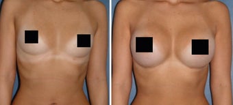 Breast Implants before 1108353
