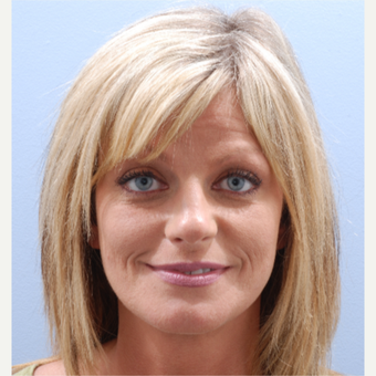 35-44 year old woman treated with Facelift after 3590231