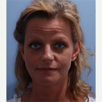35-44 year old woman treated with Facelift before 3590231
