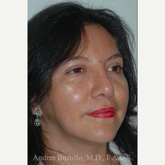 43 year old woman treated with Revision Rhinoplasty after 3460786