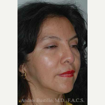 43 year old woman treated with Revision Rhinoplasty before 3460786