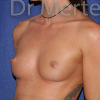 18-24 year old woman treated with Breast Augmentation before 3551992