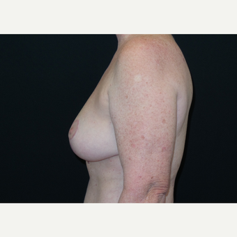 45-54 year old woman treated with Breast Lift after 3306017