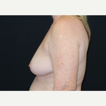 45-54 year old woman treated with Breast Lift before 3306017
