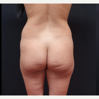 25-34 year old woman treated with Fat Transfer before 3267077