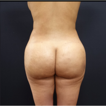 25-34 year old woman treated with Fat Transfer after 3267077