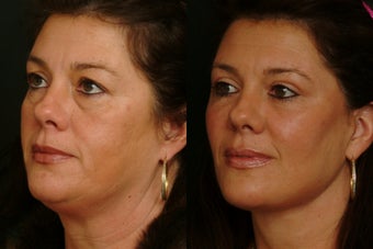 Deep Plane Lower Face Lift after 1398463