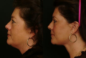 Deep Plane Lower Face Lift before 1398463