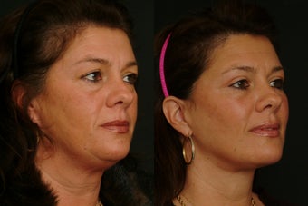 Deep Plane Lower Face Lift 1398463