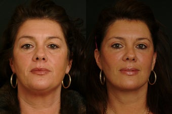 Deep Plane Lower Face Lift 1398463