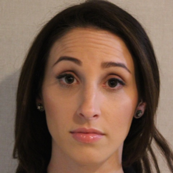 29 year old woman treated with Botox before 3836807