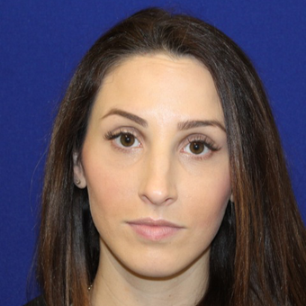 29 year old woman treated with Botox after 3836807