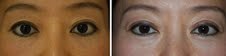 Before and After Asian Blepharoplasty for Eyelid Rejuvenation before 1094136