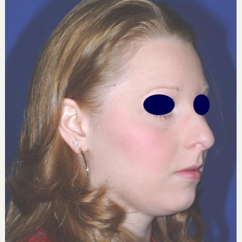 Rhinoplasty before 3324481