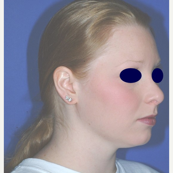 Rhinoplasty after 3324481