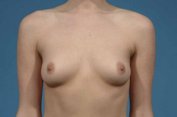 Breast Augmentation before 132009