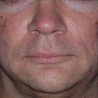 35 Year Old Male Treated for Jawline Contouring before 1367252