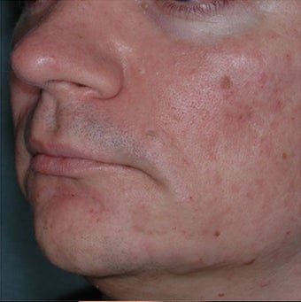35 Year Old Male Treated for Jawline Contouring 1367252