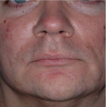 35 Year Old Male Treated for Jawline Contouring after 1367252