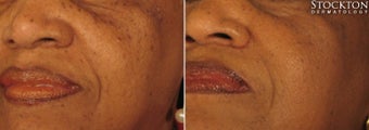 55-64 year old woman treated for Dermatosis papulosa nigra Removal (DPNs) before 2094237