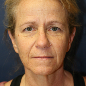 45-54 year old woman treated with Neck Lift and Face Lift and Brow Lift and Eyelid Rejuvenation before 3555322