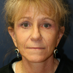 45-54 year old woman treated with Neck Lift and Face Lift and Brow Lift and Eyelid Rejuvenation after 3555322
