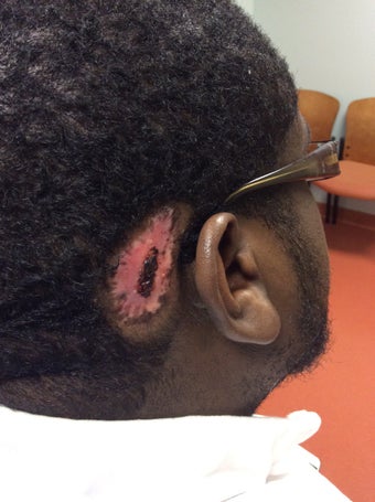 26 year old male with large keloid after 1269177