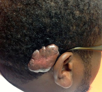 26 year old male with large keloid before 1269177