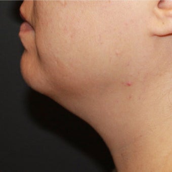 35-44 year old woman treated her double chin with Kybella before 2540109
