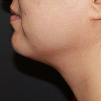 35-44 year old woman treated her double chin with Kybella after 2540109