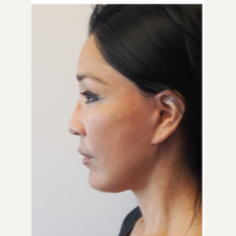 35-44 year old woman treated with Facelift after 3529985