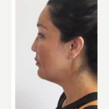 35-44 year old woman treated with Facelift before 3529985