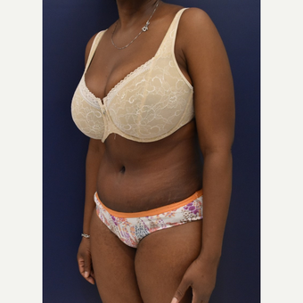 35-44 year old woman treated with Liposuction after 3033528