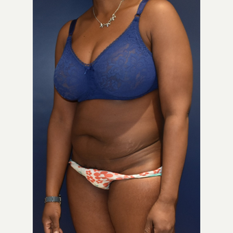 35-44 year old woman treated with Liposuction before 3033528