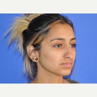 18-24 year old woman treated with Rhinoplasty before 3219738