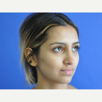 18-24 year old woman treated with Rhinoplasty after 3219738