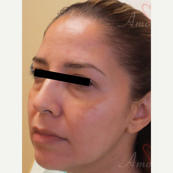35-44 year old woman treated with Bellafill before 3670688