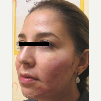 35-44 year old woman treated with Bellafill after 3670688