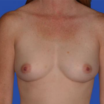 36 year old woman treated with Saline Breast Implants before 3833216