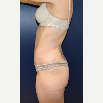 35-44 year old woman treated with Tummy Tuck after 3734119