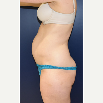 35-44 year old woman treated with Tummy Tuck before 3734119