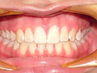 Upper space closure on a teenage patient after 1023328